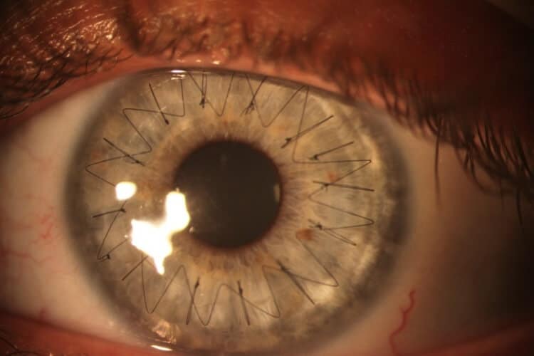 6 Buongiorno a occhi aperti - Chirurgia dei trapianti di cornea